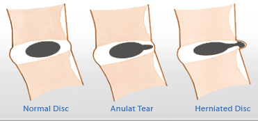 bulging disc 4
