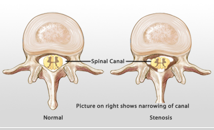 spinal stenosis
