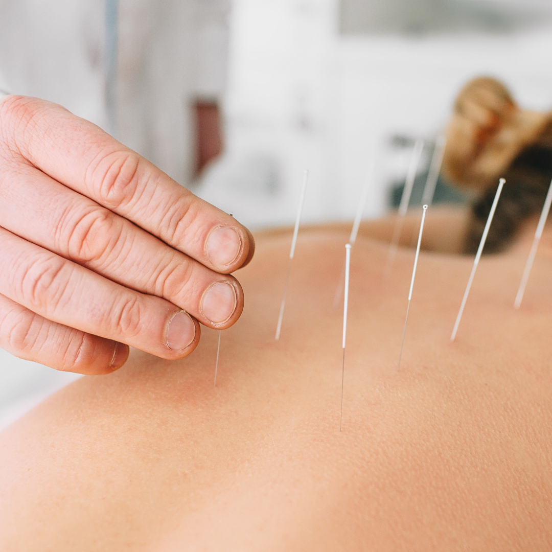 Can Acupuncture Help With Anxiety?